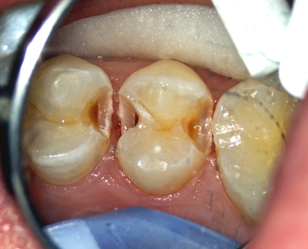 cavities 