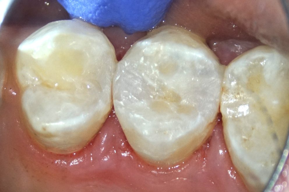 cavities filled with composite resin