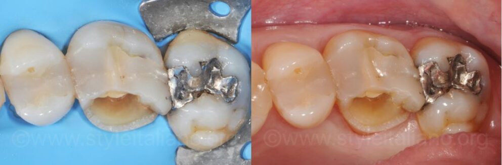 with and without rubber dam