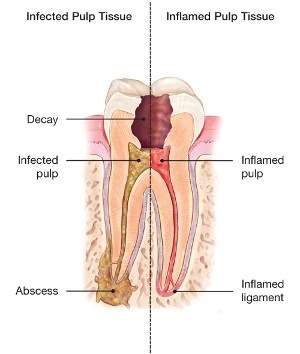 Diagram showing infected and inflamed pulp tissue requiring root canal therapy