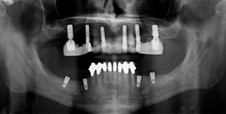 Panoramic X-ray showing All-on-4 and All-on-6 dental implant placement