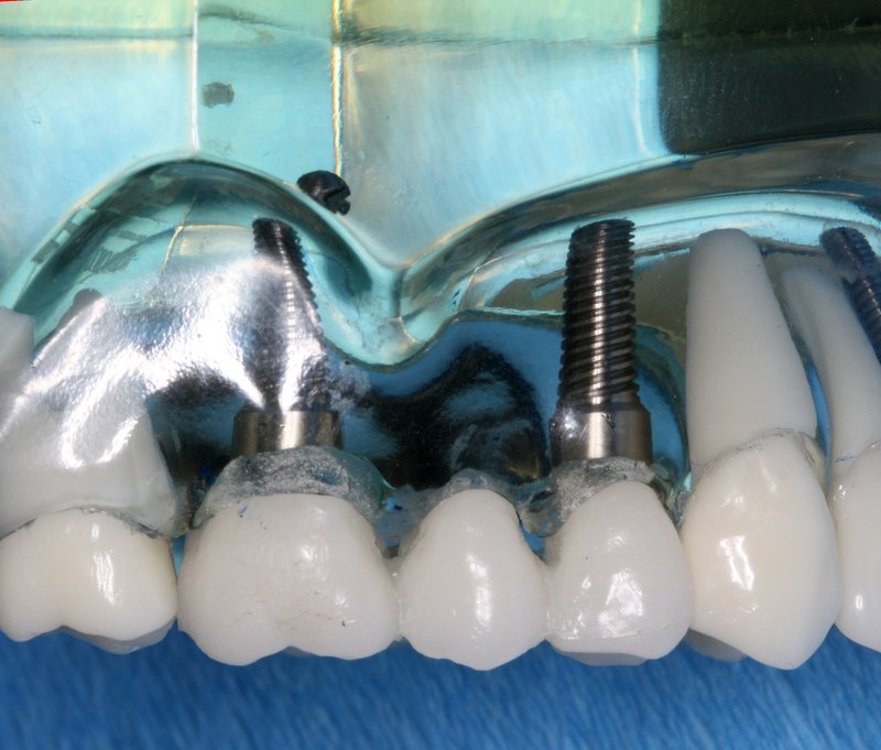 Model showing a dental bridge supported by implants