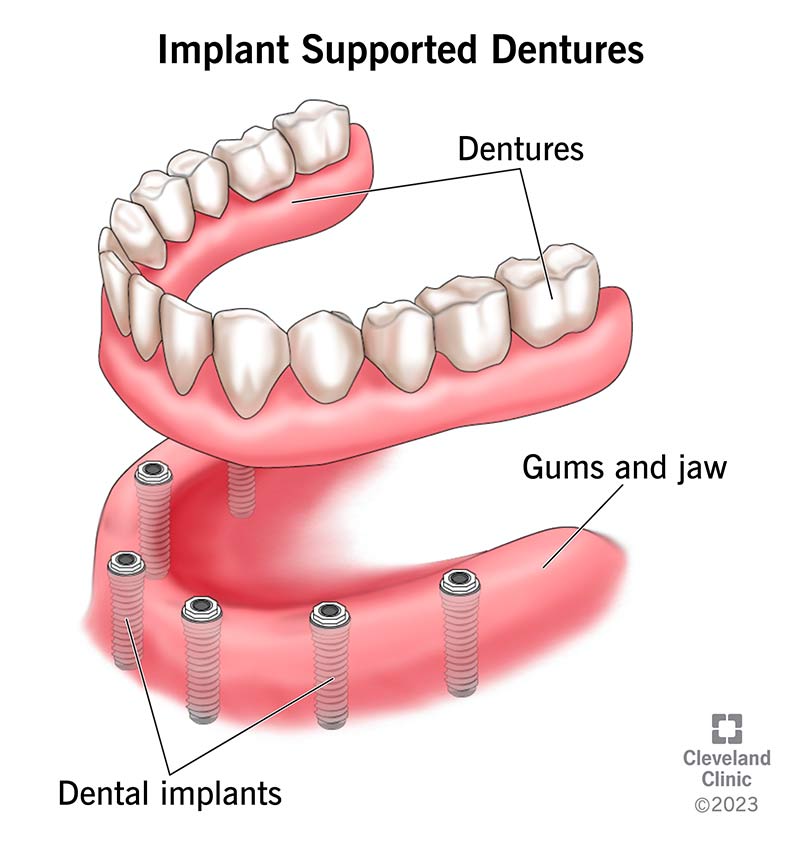 Medical illustration showing an implant-supported overdenture snapping onto dental implants in the jaw