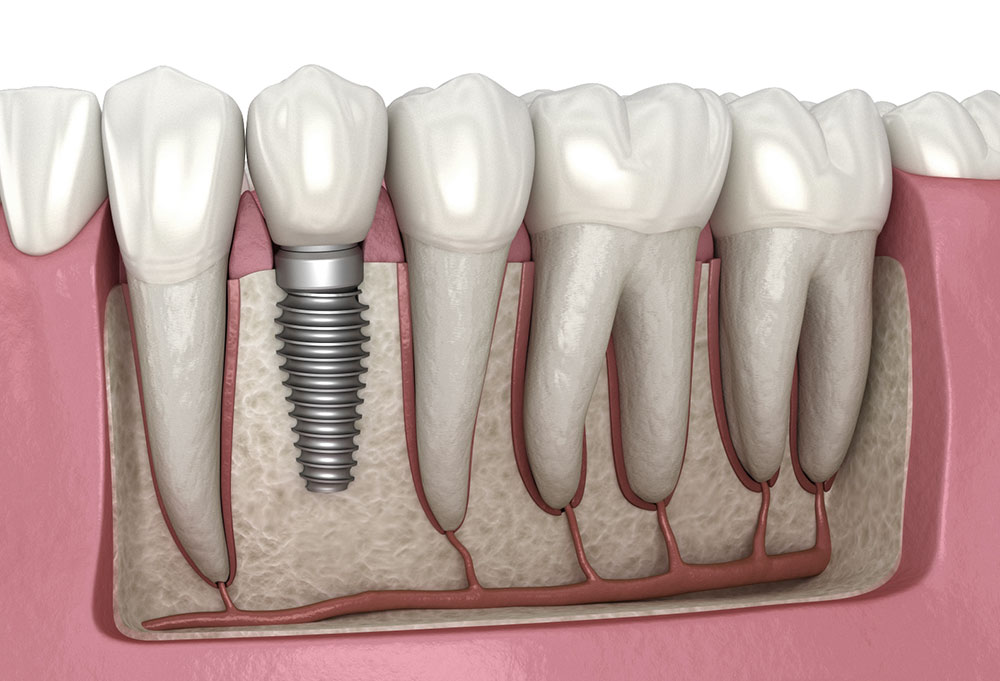 Cross-section illustration of a single dental implant placed in the jawbone